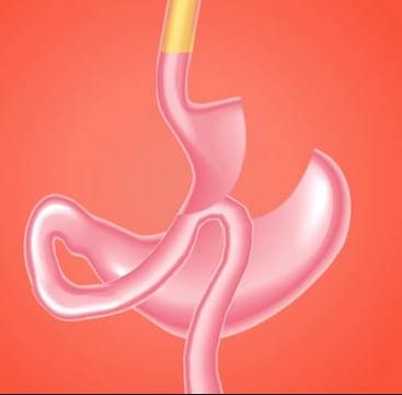 gastrik bypass ameliyatı