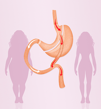 Gastrik Bypass ameliyatı sonrası mide hareketleri